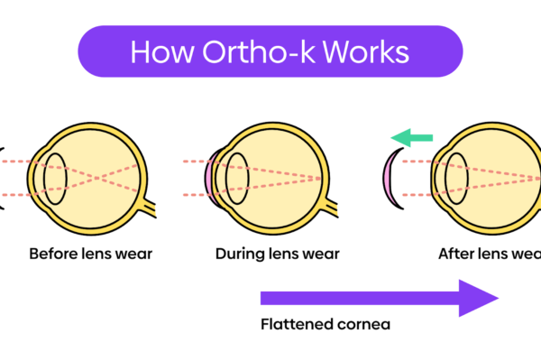 Ortho K