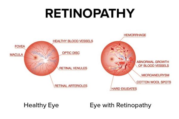 Understanding Retinopathy